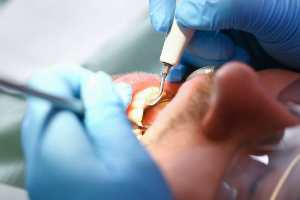 Best Emergency Wisdom Teeth Removal in Queens Gate, PA